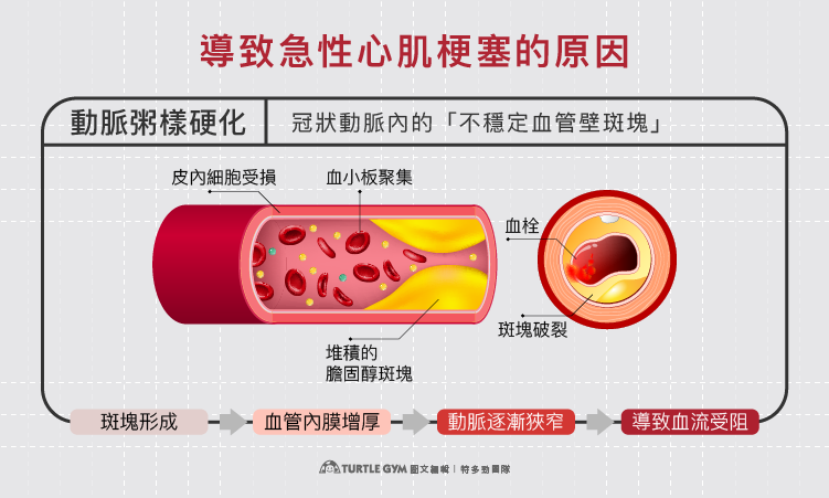 為什麼會心肌梗塞?元凶是動脈粥樣硬化&血栓形成